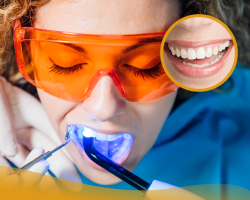 Blanchiment des dents : est-ce vraiment efficace ?