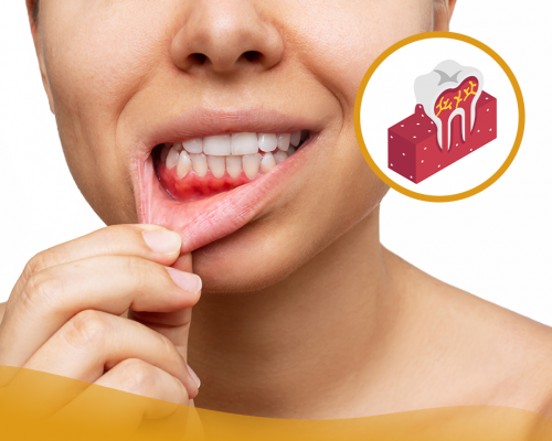Gencives sensibles : que faire quand les dents deviennent douloureuses ?